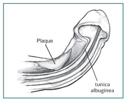 peyronies disease treatment training for doctor